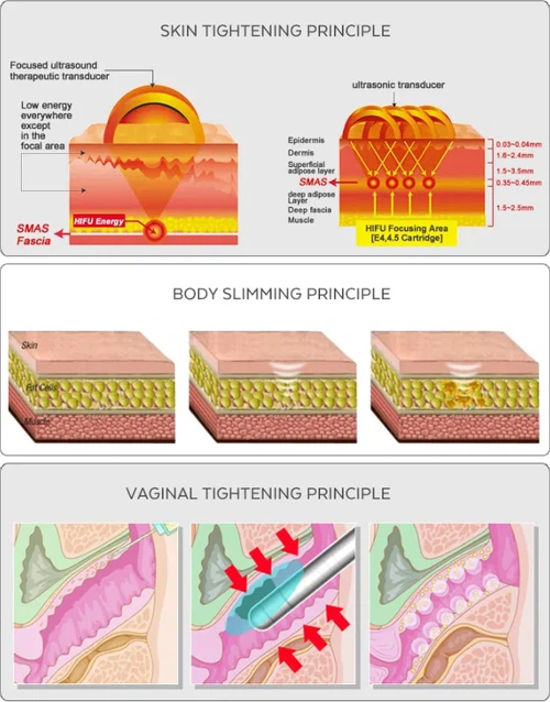 low level pelvic floor laser treatment1 low level pelvic floor laser treatment1